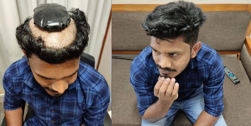 Man Smuggling 1KG Gold Stick On His Head Under Wig Got Arrested At Airport